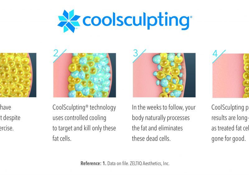 coolsculpting