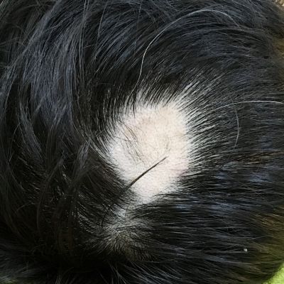 Hair Loss & Regrowth Malaysia - Hair Clinic | Revival Clinic