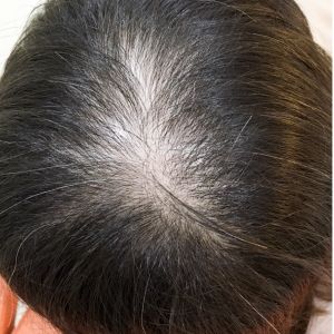 Revival Clinic|Mesotherapy for Hair Loss