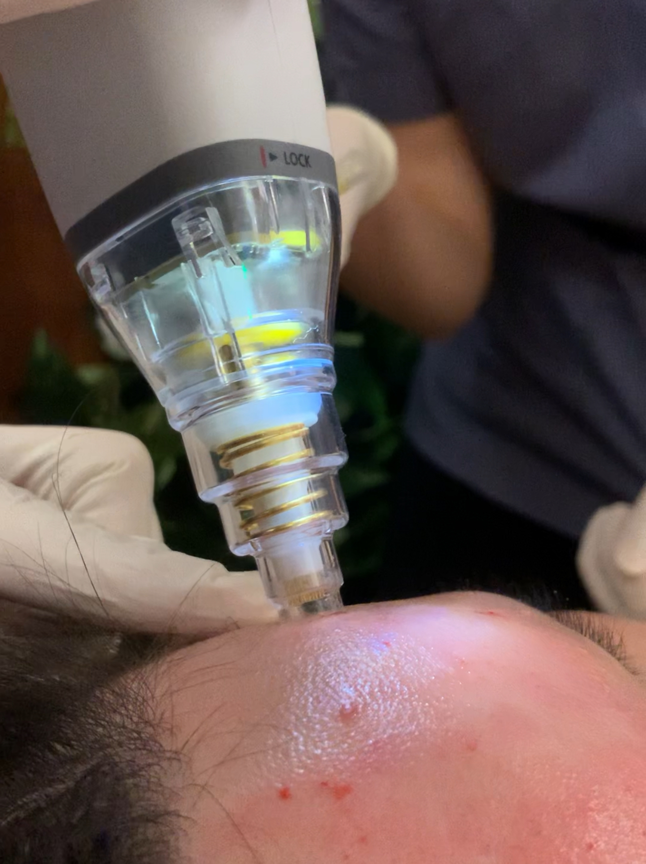 Revival Clinic|Potenza Radiofrequency Microneedling