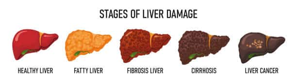 Revival Clinic | Living with Fatty Liver: From Diagnosis to Recovery