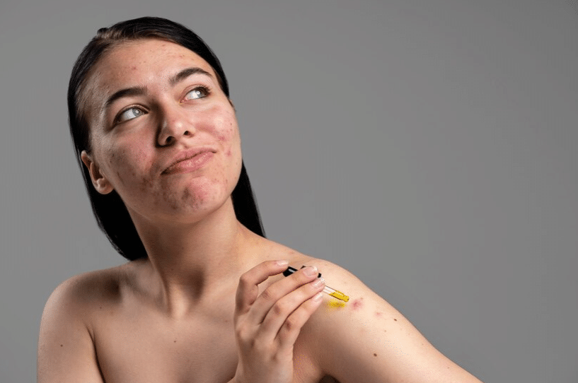 Revival Clinic | Say Goodbye to Acne Scars Naturally: A Comprehensive Guide