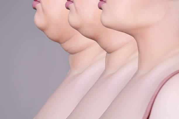 Revival Clinic | Chin Up: Your Guide to Tackling Double Chins!