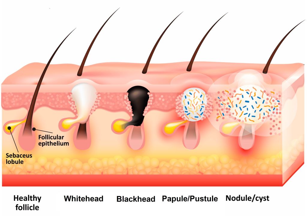 pathophysiology of acne 