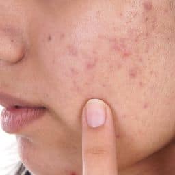 Revival Clinic | Understanding Acne: Discovering Your Path to Clear Skin