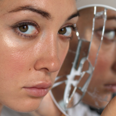 Melasma Treatments